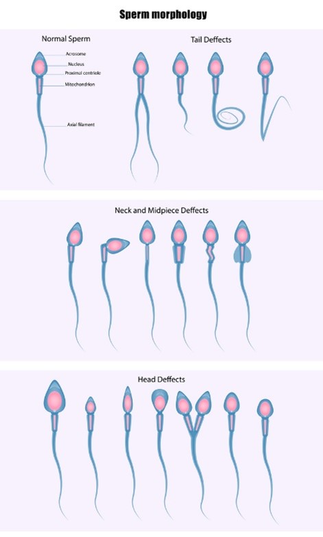 Sperm morphology including tail, midsection and head defects