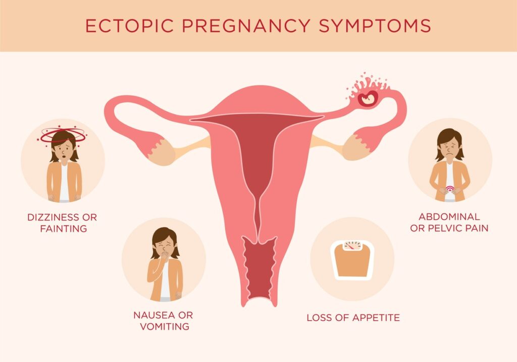 Diagram showing the various symptoms associated with an Ectopic Pregnancy