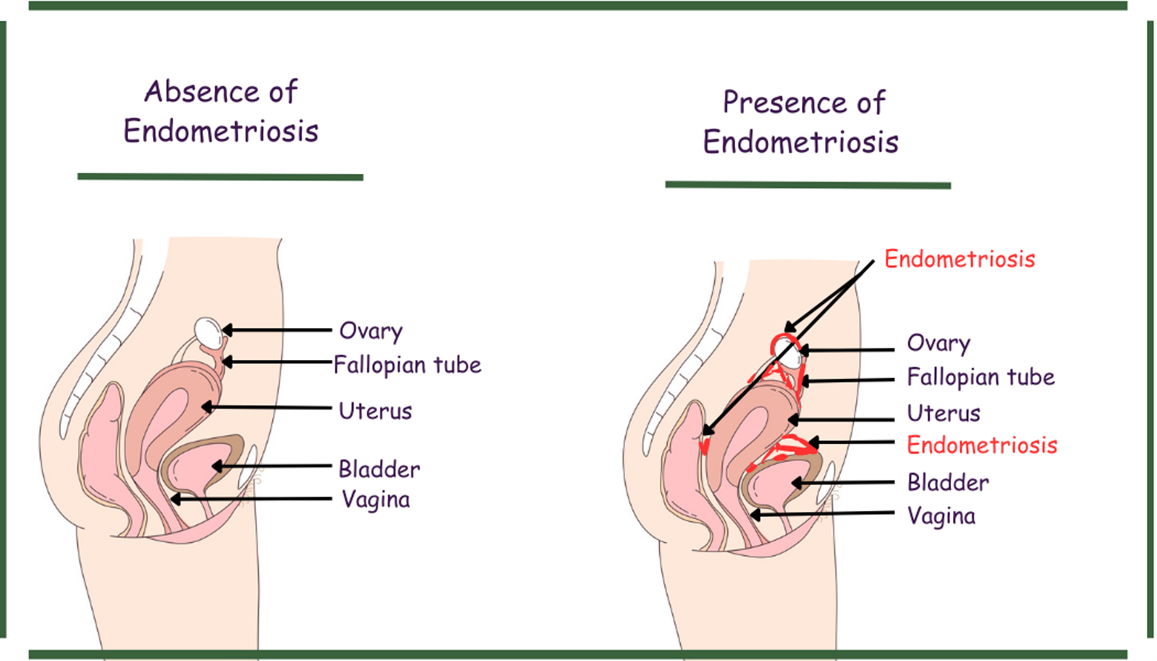 diagram showing a side view of a woman's abdomen showing the areas that Endometriosis can attach to