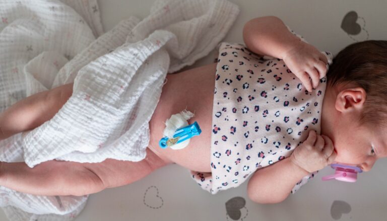 Umbilical Cord shown on a baby