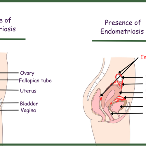 diagram showing a side view of a woman's abdomen showing the areas that Endometriosis can attach to