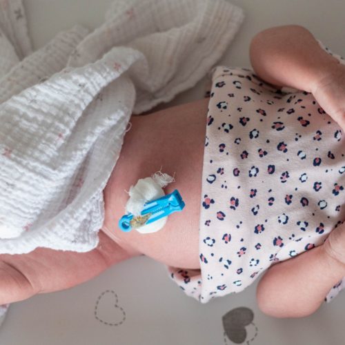 Umbilical Cord shown on a baby